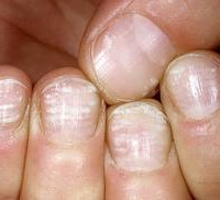определение болезни по ногтям на руках